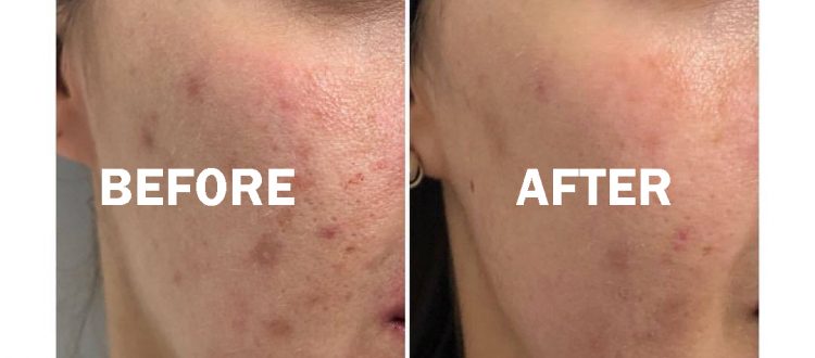 Before and after for Active Acne Treatment