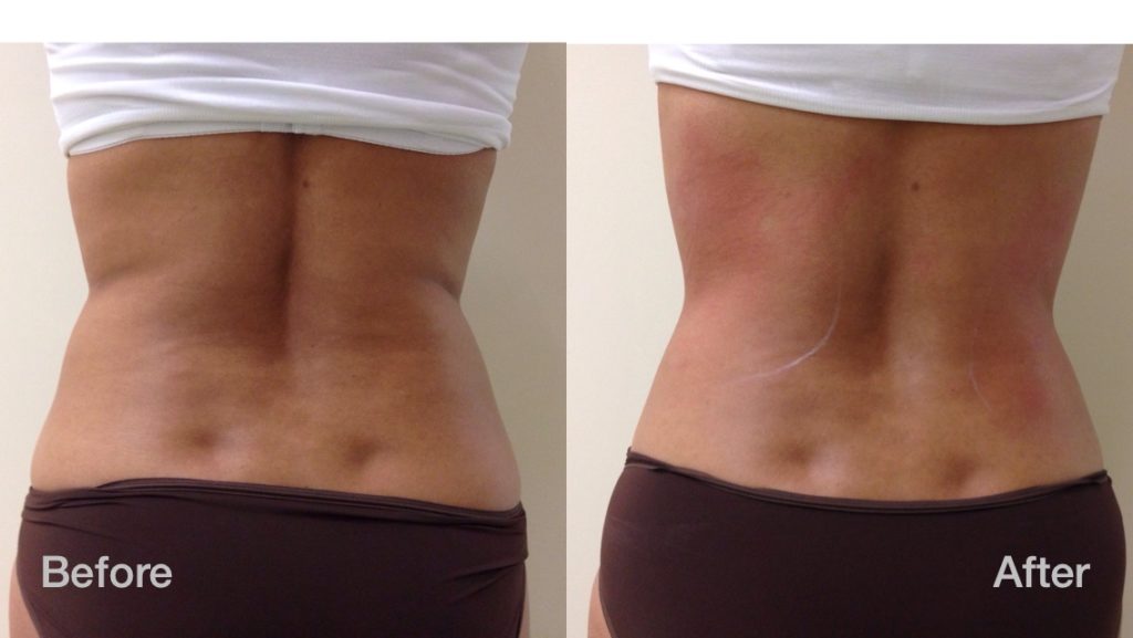 Body Sculpting Before & After 1