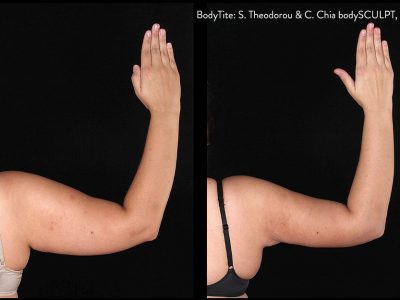 Body Sculpting Before & After 2